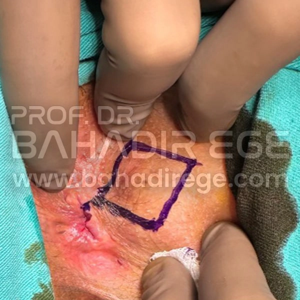 Anal Darlık Anal Darlık