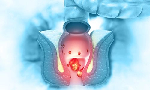 Anal Fissür Nedir? Belirtileri, Tedavisi ve Ameliyatı