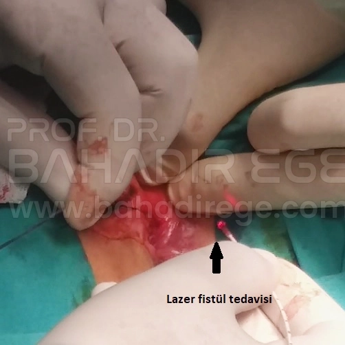 Anal Fistül Ameliyatı Anal Fistül Ameliyatı