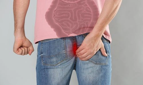 Anal Fistül Nedir? Tanısı, Tedavisi ve Ameliyatı