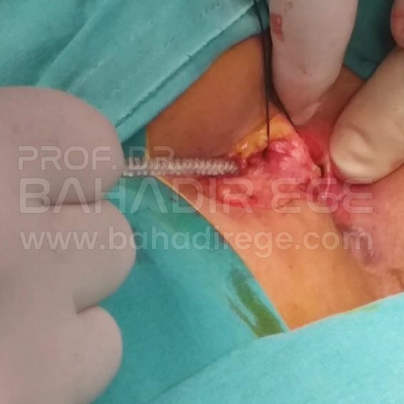 Anal Fistül Tedavisi Anal Fistül Tedavisi