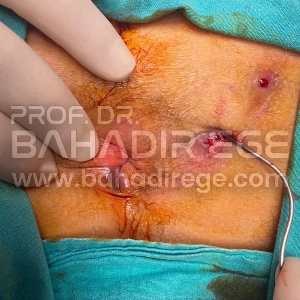 Anal Fistül Tedavisi Zo Mu Anal Fistül Tedavisi Zo Mu