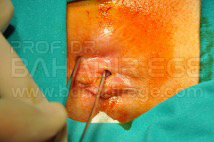 Hemoroid ameliyatı sonrası gelişen anal stenoz