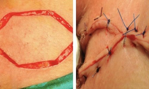 Analstenozda Flap Onarım (Anoplasti) Analstenozda Flap Onarım (Anoplasti)