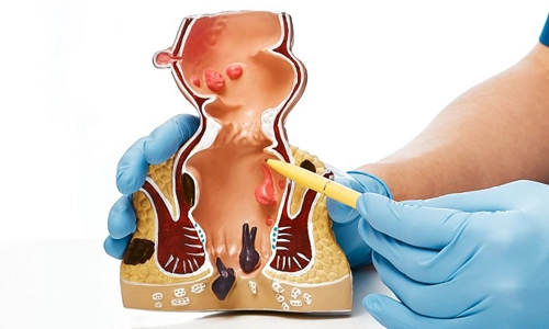 Atnalı Fistül Nedir? Tanısı, Belirtileri ve Ameliyatı