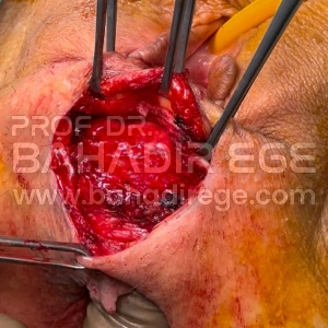 Bağırsak Fıtığı Tanısı Bağırsak Fıtığı Tanısı