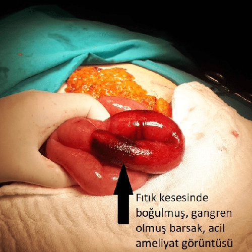 Bağırsak Gangreni Ameliyatı Bağırsak Gangreni Ameliyatı