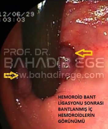 Hemoroidal Hastalıkta Bant Ligasyonu