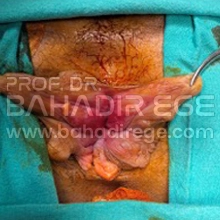 Hemoroid Belirtileri Hemoroid Belirtileri