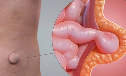 Göbek Fıtığı Nedir? Tanısı, Tedavisi ve Ameliyatı