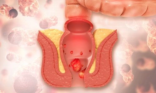 Hemoroid (Basur) Nedir? Tanısı, Evreleri, Lazerle Tedavisi