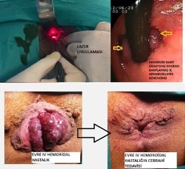 Hemoroid Tedavisi Yöntemleri: En İyi Hemoroid Tedavisi