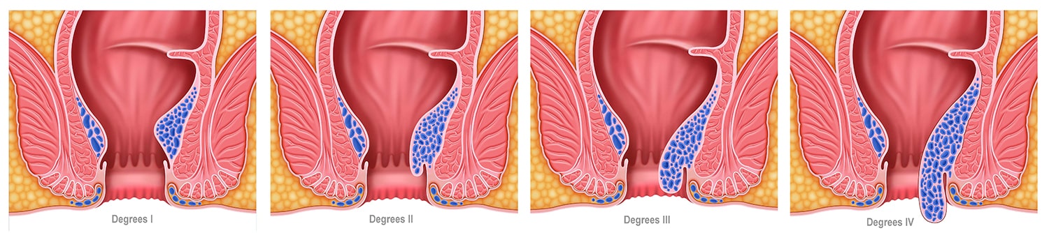 Hemoroidal Hastalık Evreleri