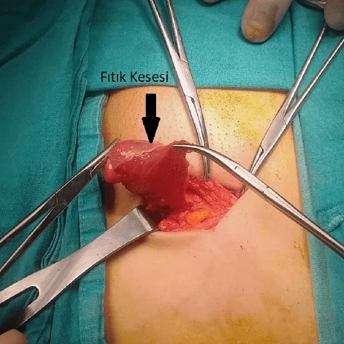 Kasık Fıtığı Görüntüsü