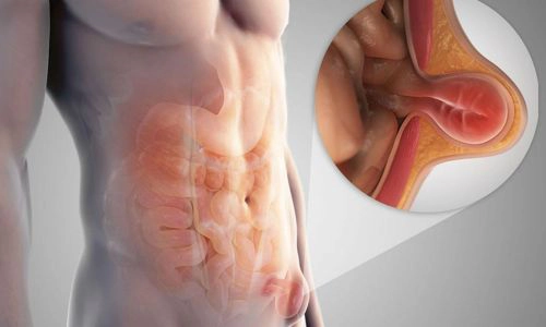 Kasık Fıtığı Nedir? Nedenleri, Belirtileri ve Ameliyatı