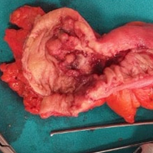 Kolon Kanseri Görüntüsü Kolon Kanseri Görüntüsü