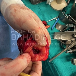 Kolon Kanserinde Bitkisel Kür Kullanımı Kolon Kanserinde Bitkisel Kür Kullanımı