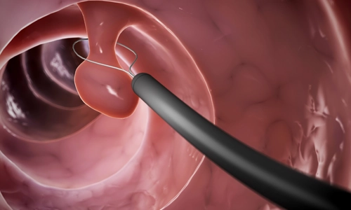 Kolonoskopi Nedir? Tedavisi Eder Mi? Neden Yaptırmalıyız?