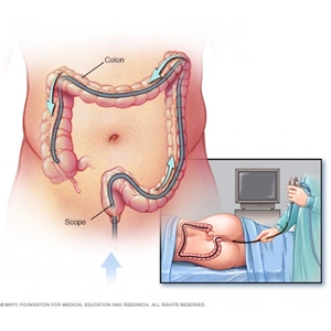 Kolonoskopi İşlemi Kolonoskopi İşlemi