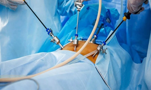 Laparoskopik Cerrahi Nedir? Ameliyatları ve Avantajları