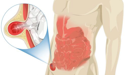 Laparoskopik Fıtık Cerrahisi Nedir? Yöntemi ve Avantajları