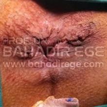 Hemoroid (Basur) Tedavisi Hemoroid (Basur) Tedavisi