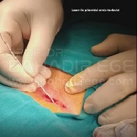 Lazerle Kıl Dönmesi Tedavisi