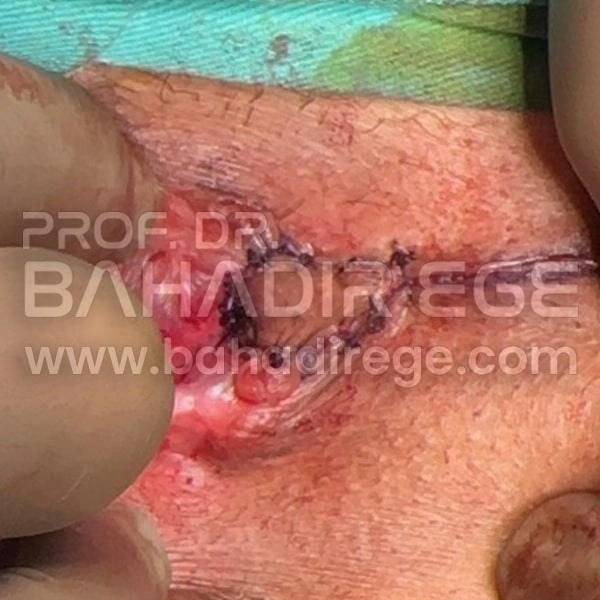 Makat Stenozu Makat Stenozu