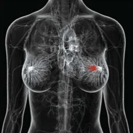 Meme Kanserinin Belirtileri Meme Kanserinin Belirtileri