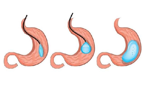Mide Balon Uygulaması (Gastric Balloon)