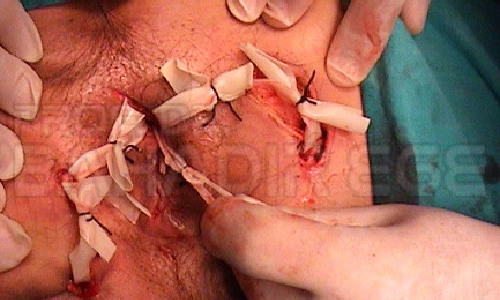 Modifiye Hanley Prosedürü Modifiye Hanley Prosedürü