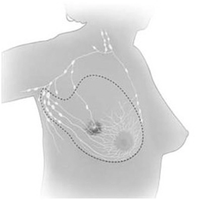 Modifiye Radikal Mastektomi Modifiye Radikal Mastektomi