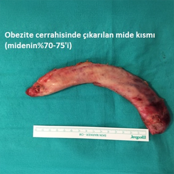 Obezite Cerrahisi ile Çıkarılan Midenin Bir Kısmı