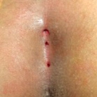 Kıl Dönmesi (Pilonidal Sinus)