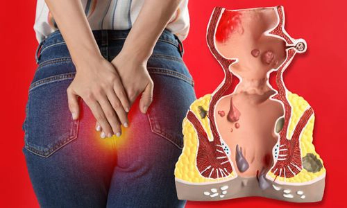 Proktolojik Hastalık Nedir? Nedenleri ve Tedavisi