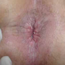 Pruritus Ani (Makat Kaşıntısı) Nedenleri Pruritus Ani (Makat Kaşıntısı) Nedenleri