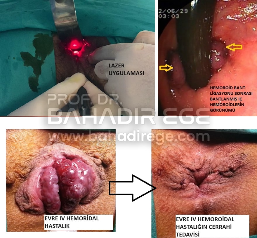 Ramazanda Hemoroid Hastalığı