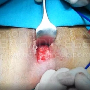 Rektosel Tedavisi Rektosel Tedavisi