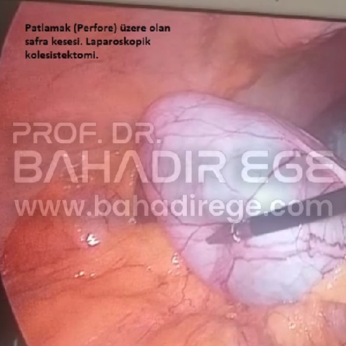 Patlamak Üzere Olan Safra Kesesi Patlamak Üzere Olan Safra Kesesi