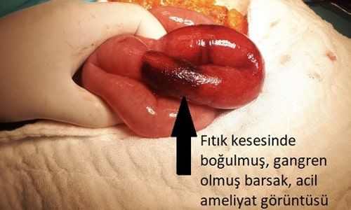 Boğulmuş (İnkarsere - Strangüle) Fıtık