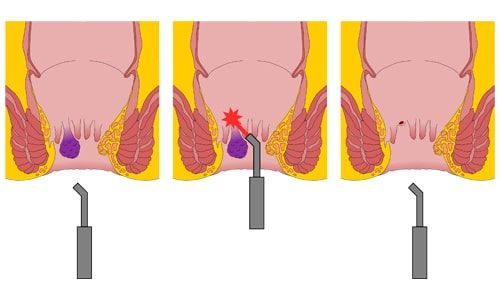 Hemoroidal (Basur, Hemoroid) Hastalık İçin En Uygun Tedavi Seçeneği Nedir?