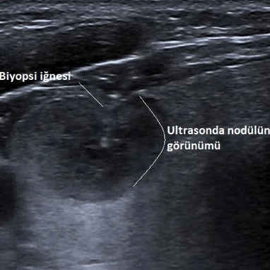 Tiroid İnce İğne Aspirasyon Biyopsisi (TİİAB) Tiroid İnce İğne Aspirasyon Biyopsisi (TİİAB)