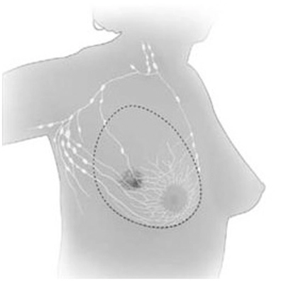 Total Mastektomi Total Mastektomi