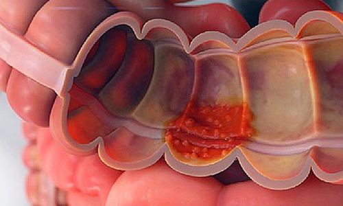 Ülseratif Kolit Nedir? Nedenleri ve Tedavisi