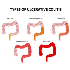 Ülseratif Kolit Tipleri Ülseratif Kolit Tipleri
