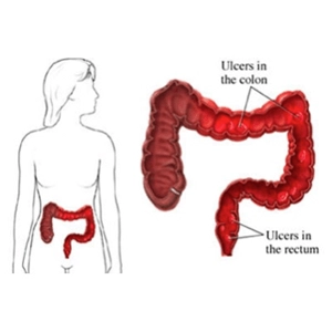 Ülseratif Kolit Hastalığı Ülseratif Kolit Hastalığı