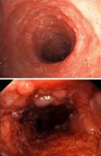 Crohn Hastalığı ve Ülseratif Kolitle Arasındaki Fark