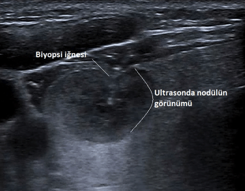 Paratiroid Adenomu Tanısı