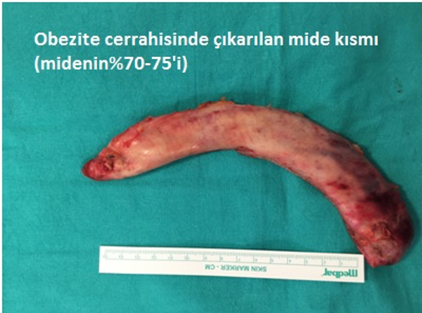 Obezite Cerrahisi Ameliyatı