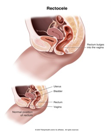 Rektosel Tedavisi